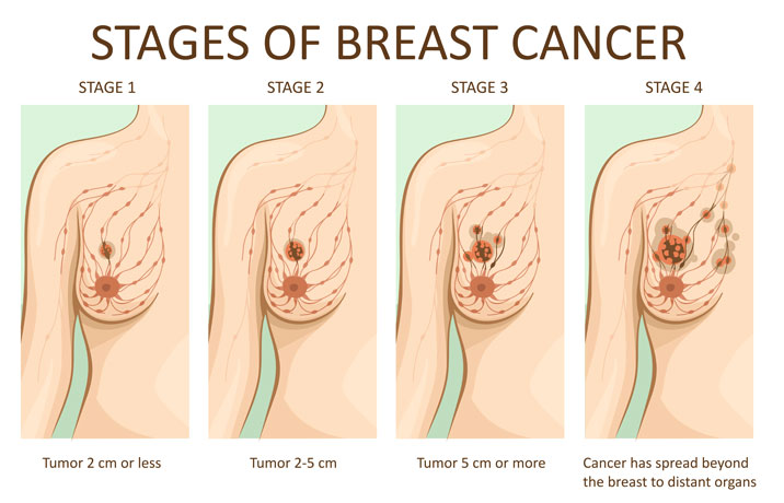breast cancer assessed stage